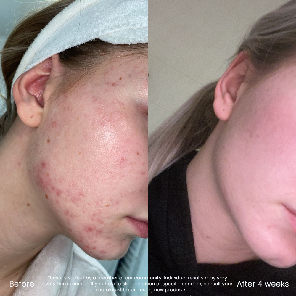 Hyaluronic Acid Set For Dry Skin & Natural Glow