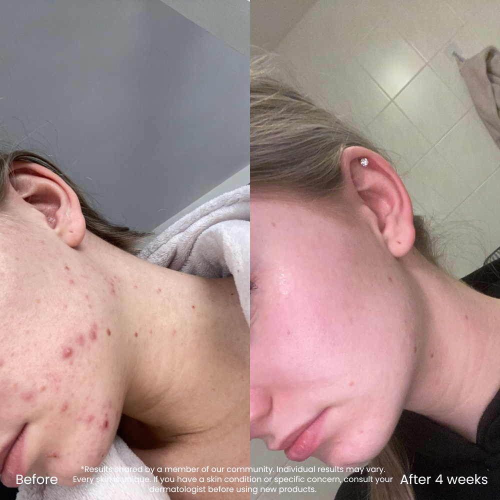 10% Niacinamide Serum Voor Een Zuivere Huid