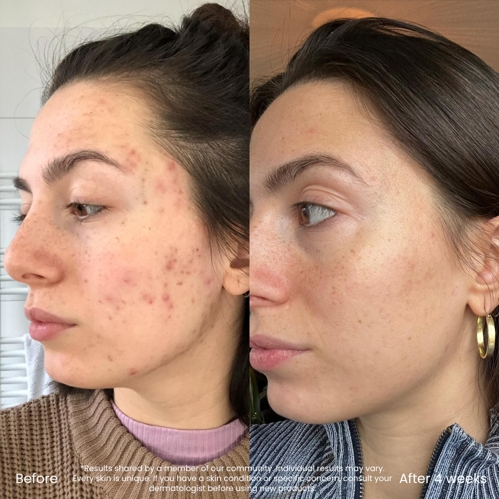 Vitamine C Serum Voor Pigmentvlekken & Roodheid