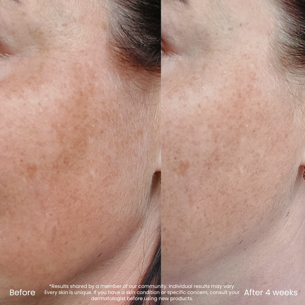 Vitamine C Serum Voor Pigmentvlekken & Roodheid