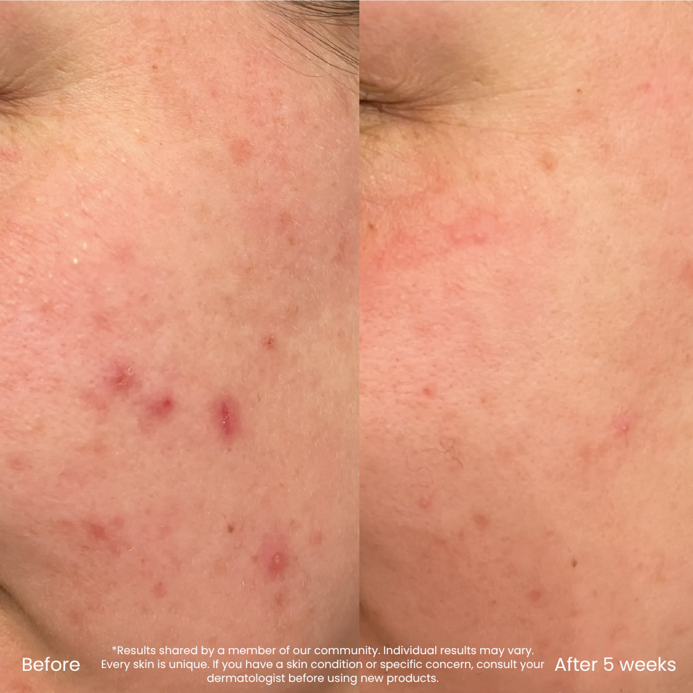 BHA/AHA Exfoliant For Pores & Uneven Skin Texture