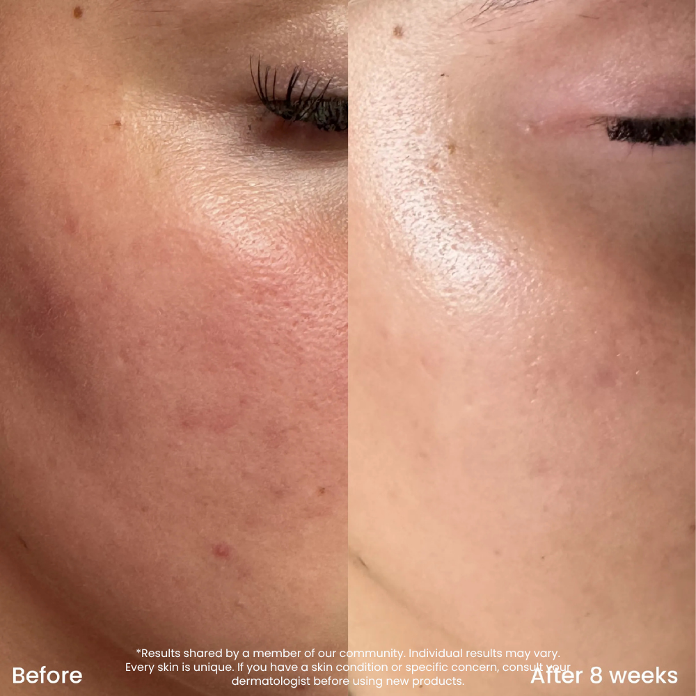 10% Niacinamide Serum Voor Een Zuivere Huid