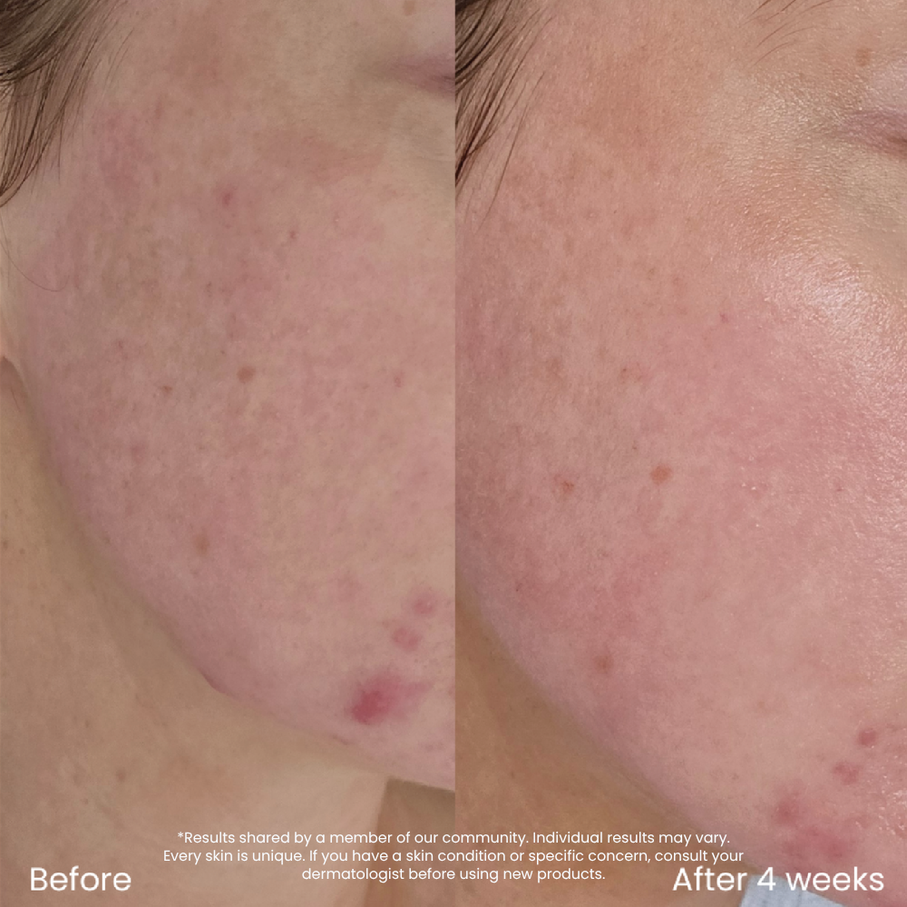 Hyaluronic Acid Set For Dry Skin & Natural Glow