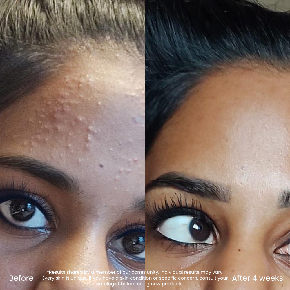 BHA/AHA Exfoliant Voor Poriën & Oneffen Huidtextuur