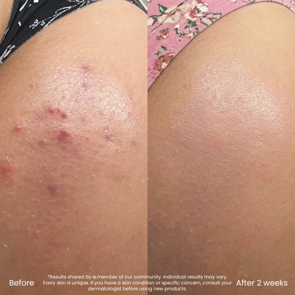 Hyaluronzuur Hydraterende Bodylotion Voor De Droge Huid